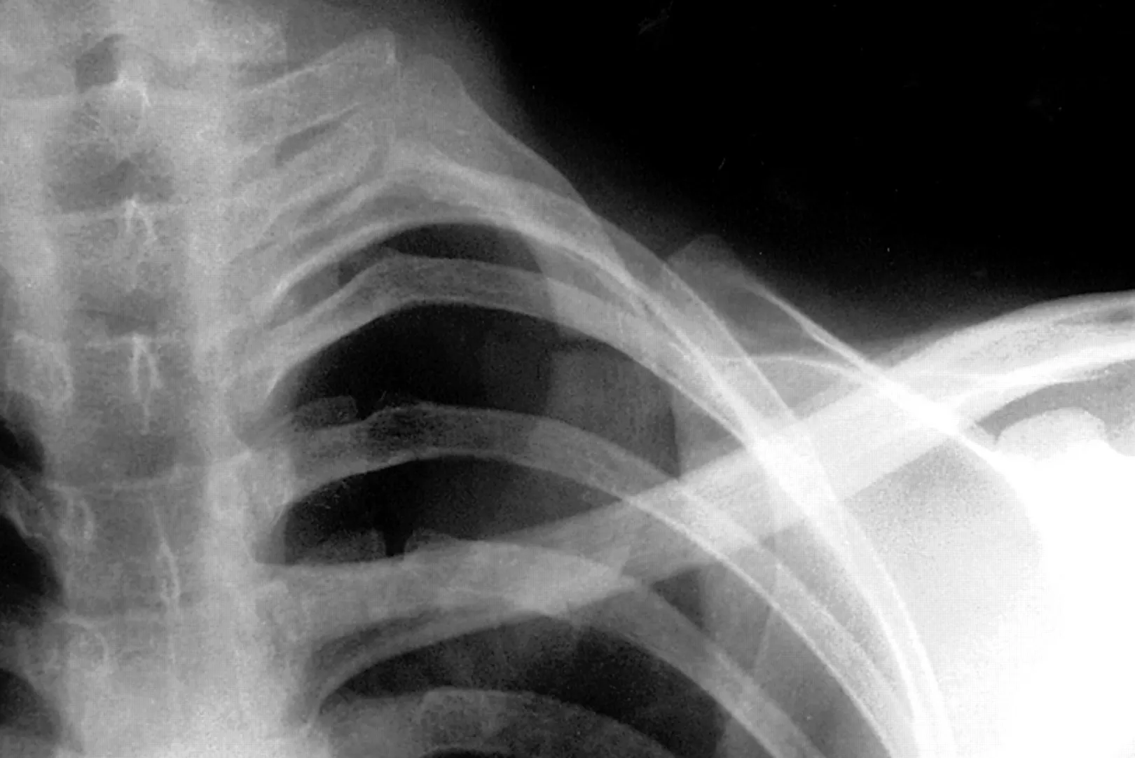 Lesiones de Costillas (Fracturas, Esguinces)