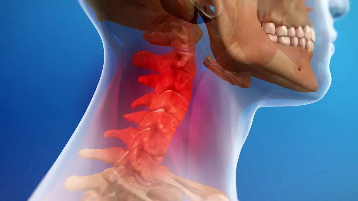 Lesiones por Latigazo Cervical (Whiplash)