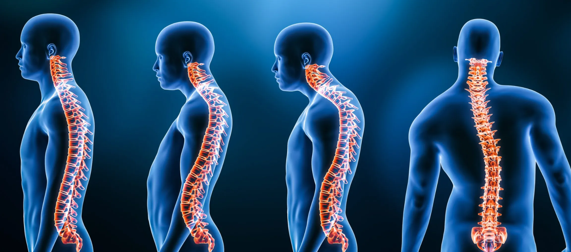 Lordosis y Cifosis Excesiva