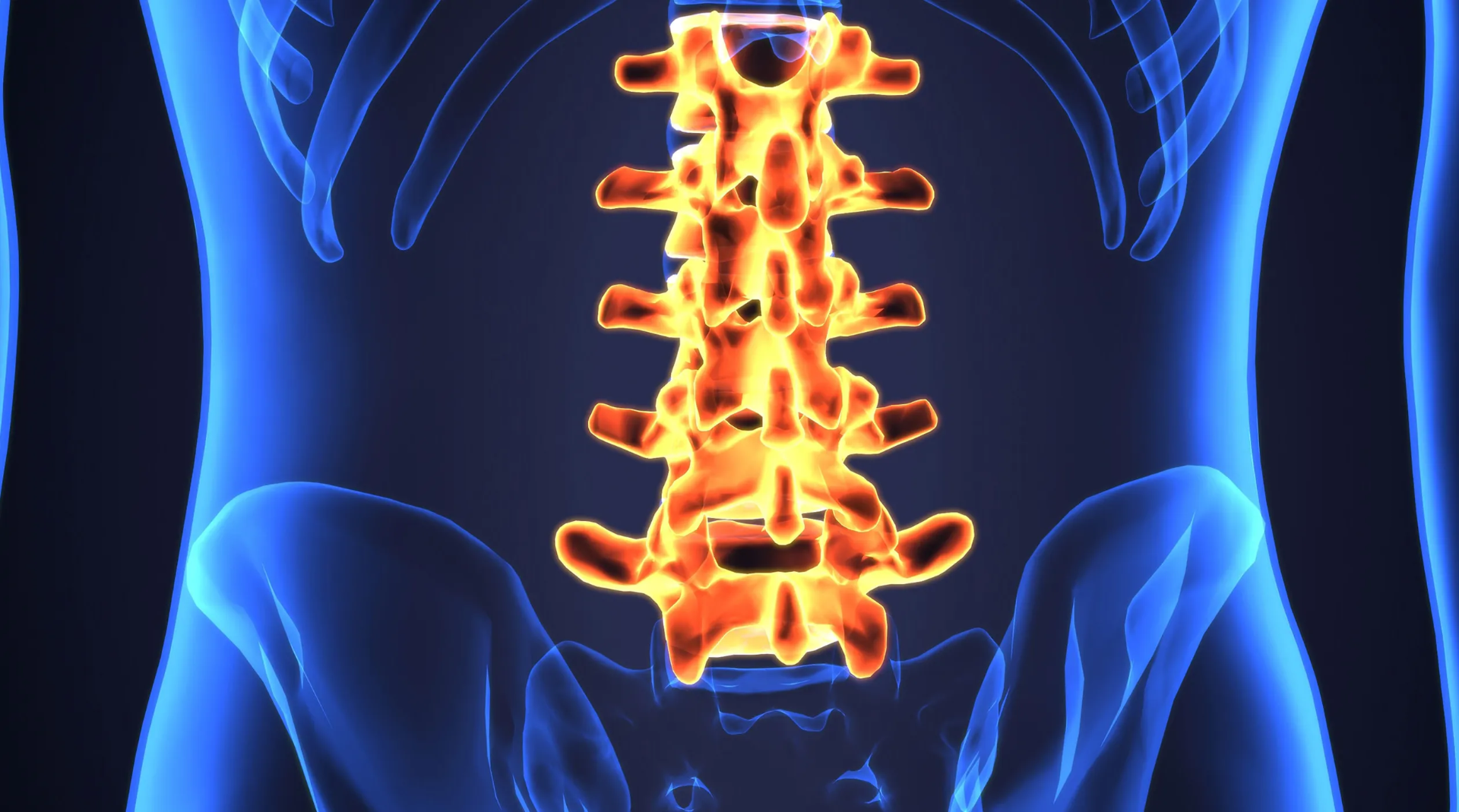Lordosis Lumbar Excesiva