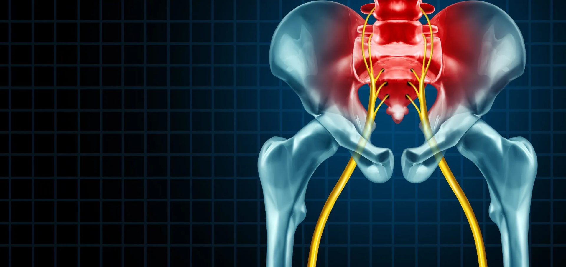 Neuralgia del Ciático
