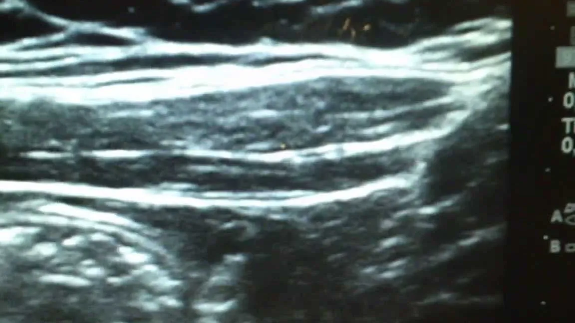 Neuralgia del Iliohipogástrico