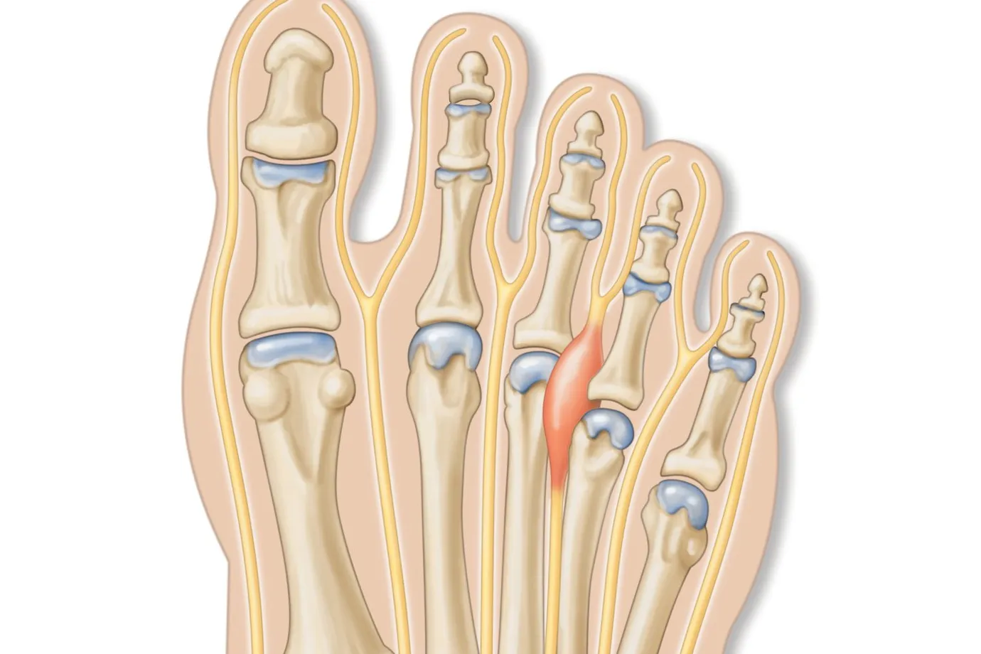 Neuroma de Morton