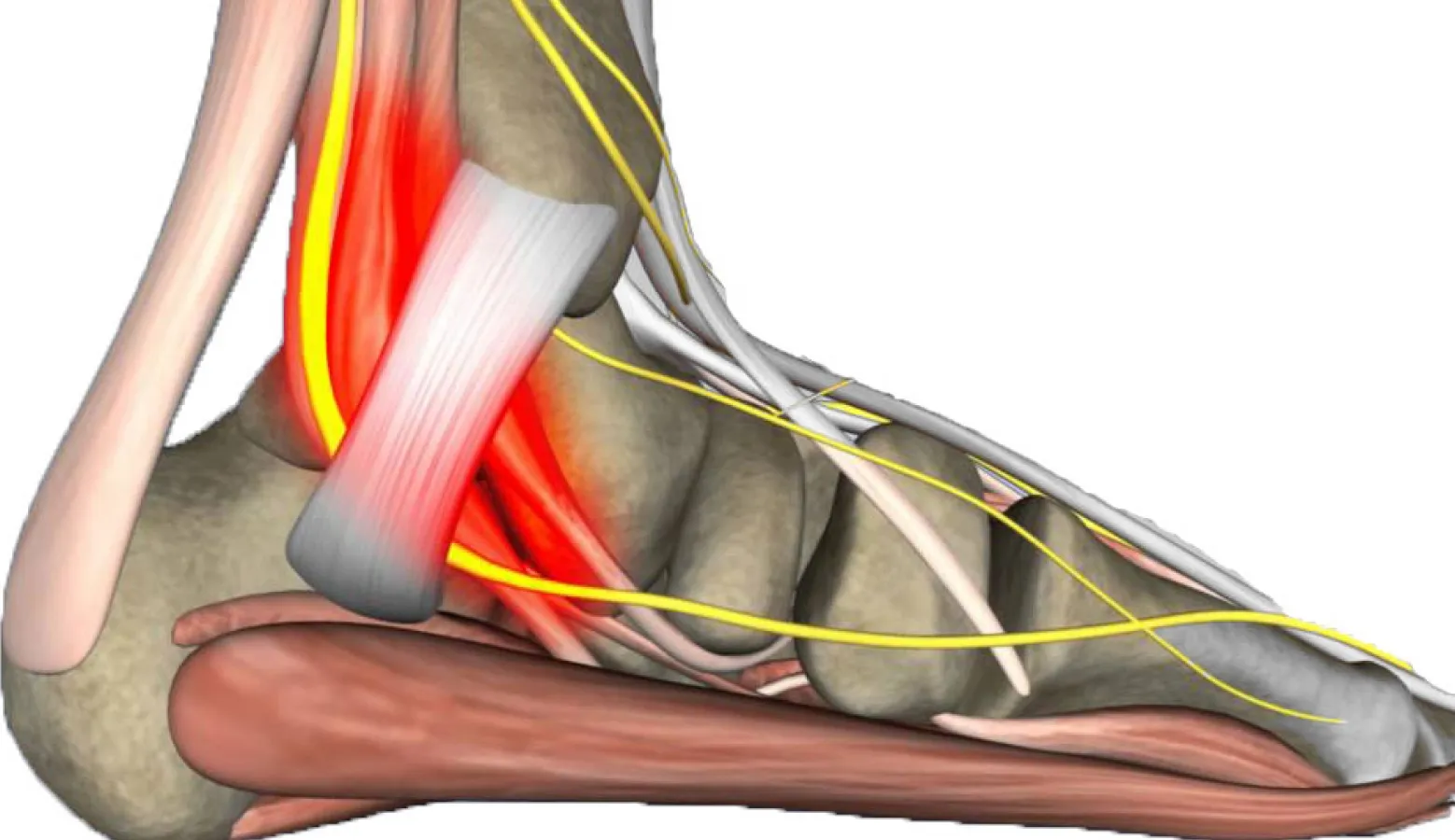 Neuropatía del Nervio Tarsiano