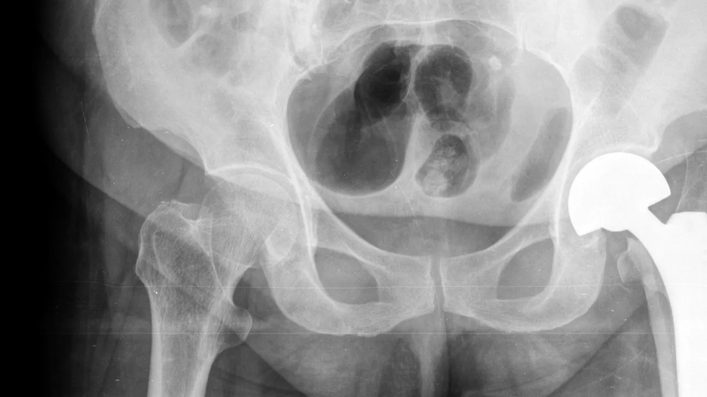 Osteoartritis de cadera