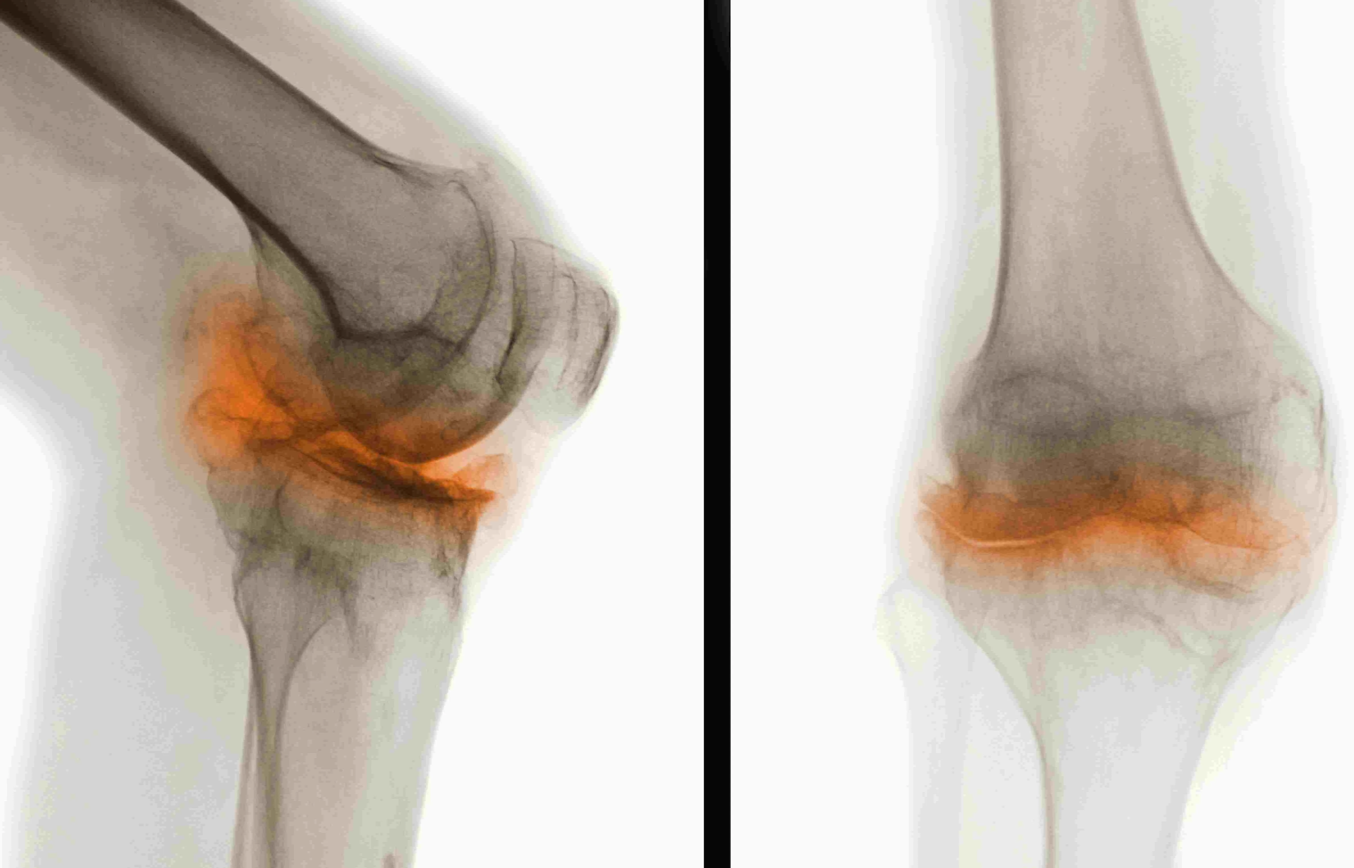 Osteoartritis de rodilla