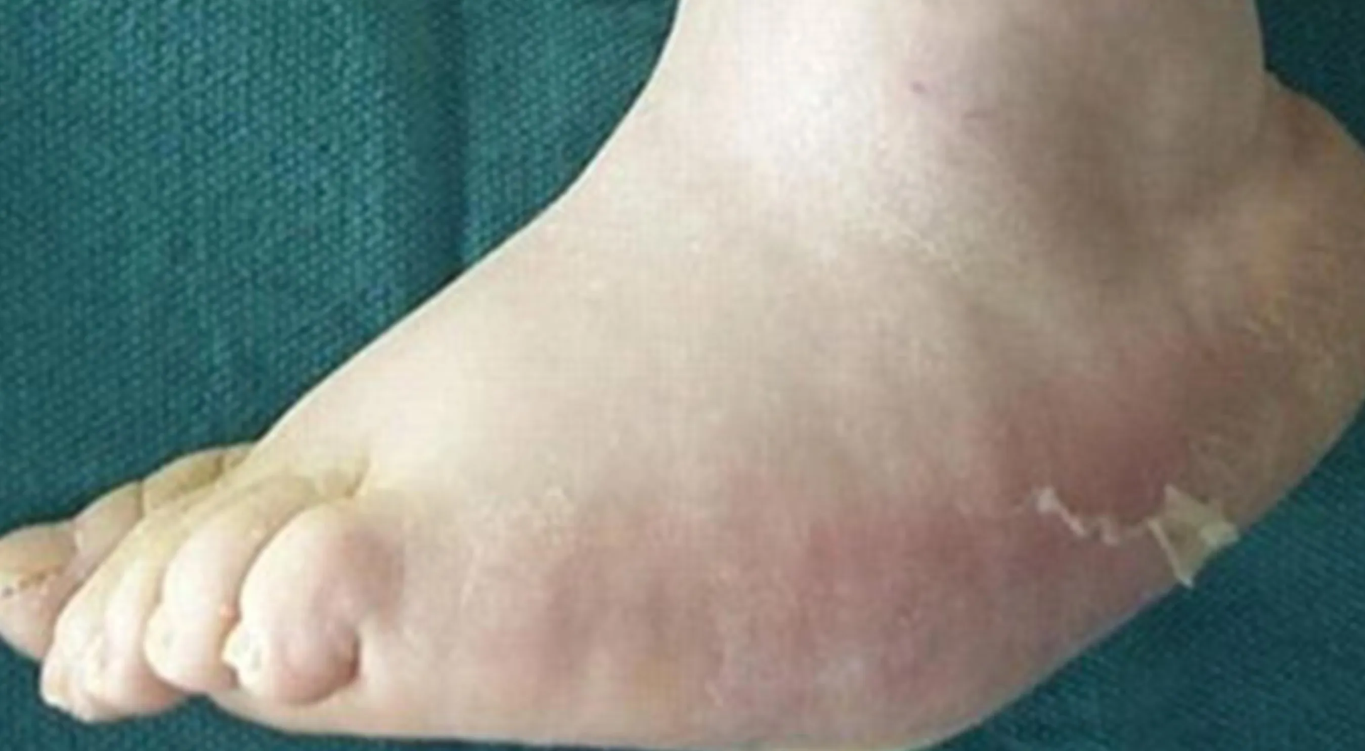 Pie de Charcot