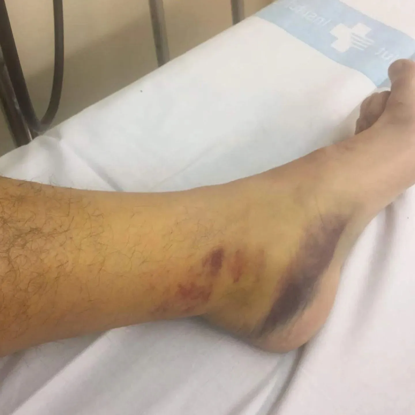Recuperación post-ruptura de fibras
