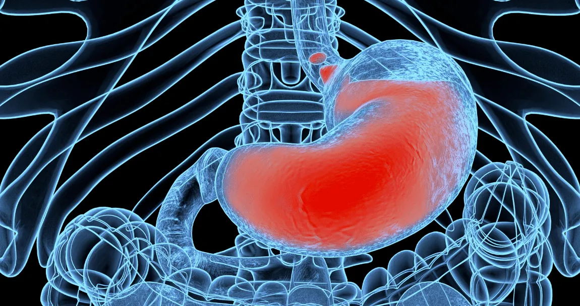 Reflujo gastroesofágico en pediatría