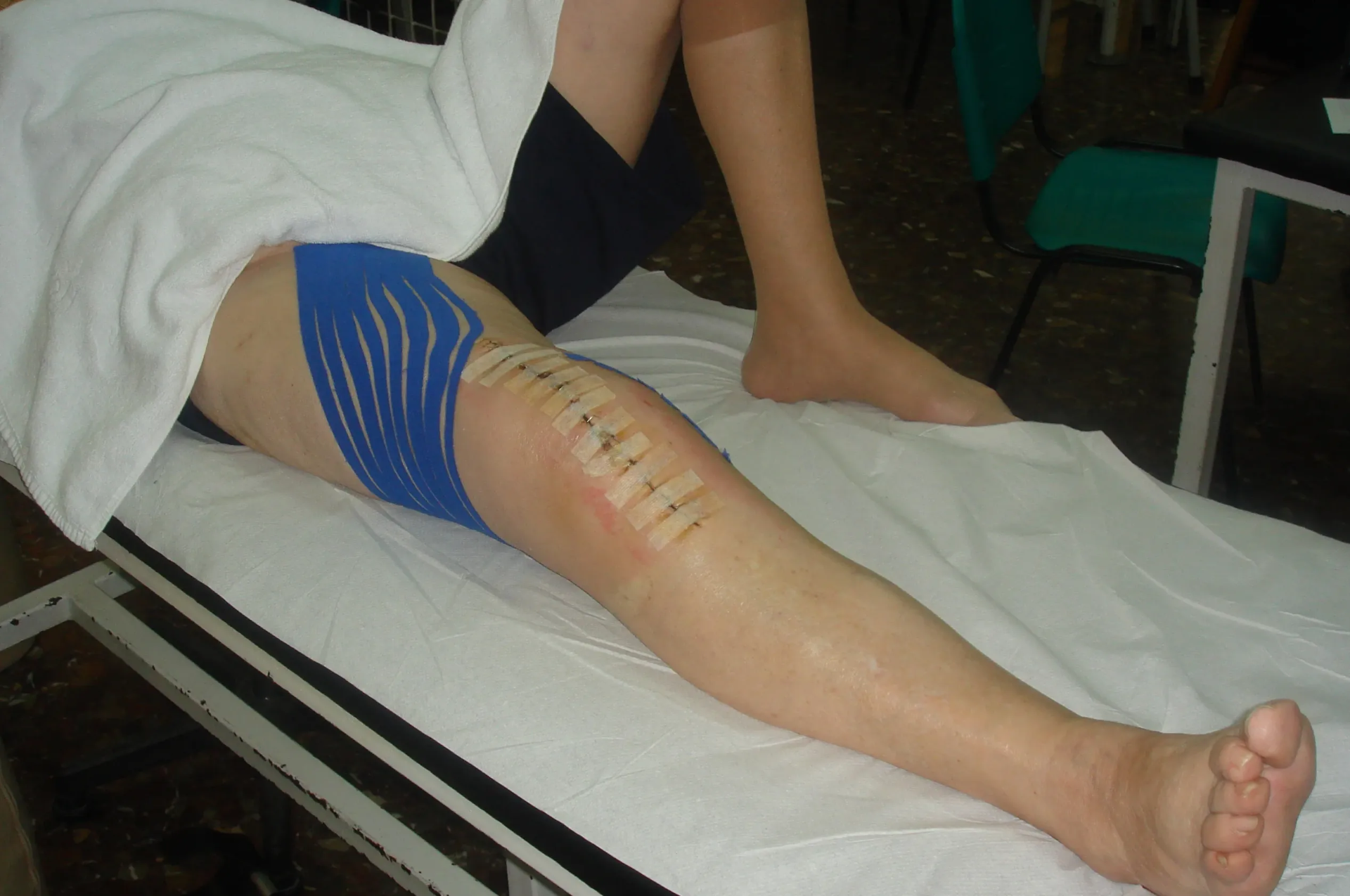 Rehabilitación de Prótesis de Rodilla