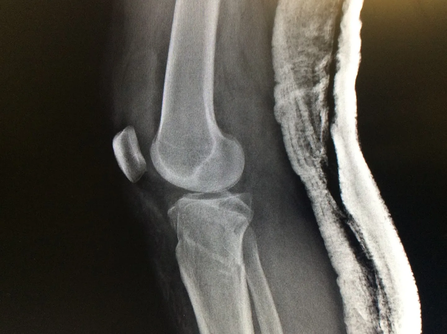 Rotura de meseta tibial