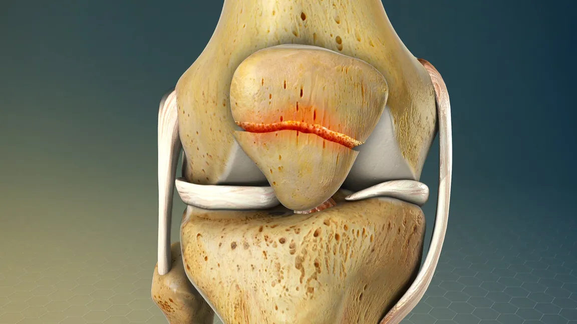 Rotura de ligamentos de la rodilla