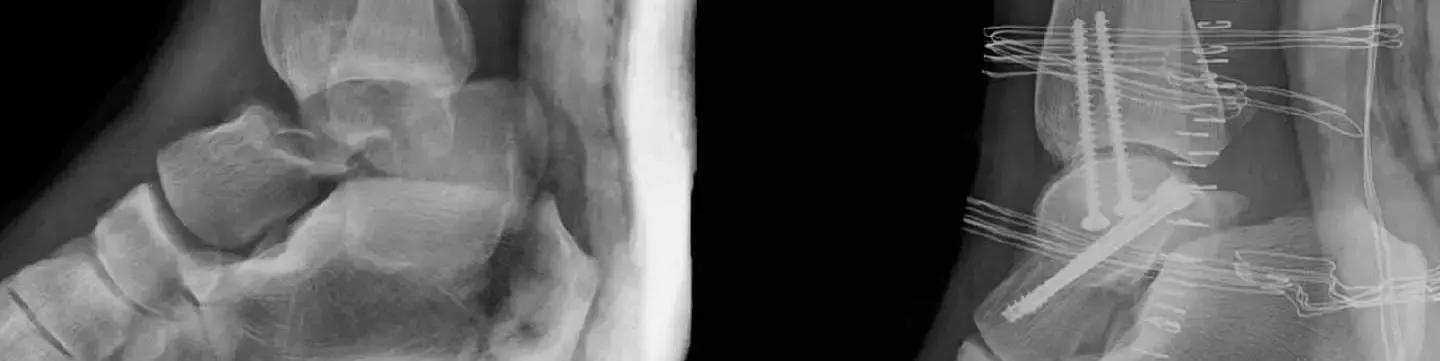 Síndrome de Fractura por Estrés