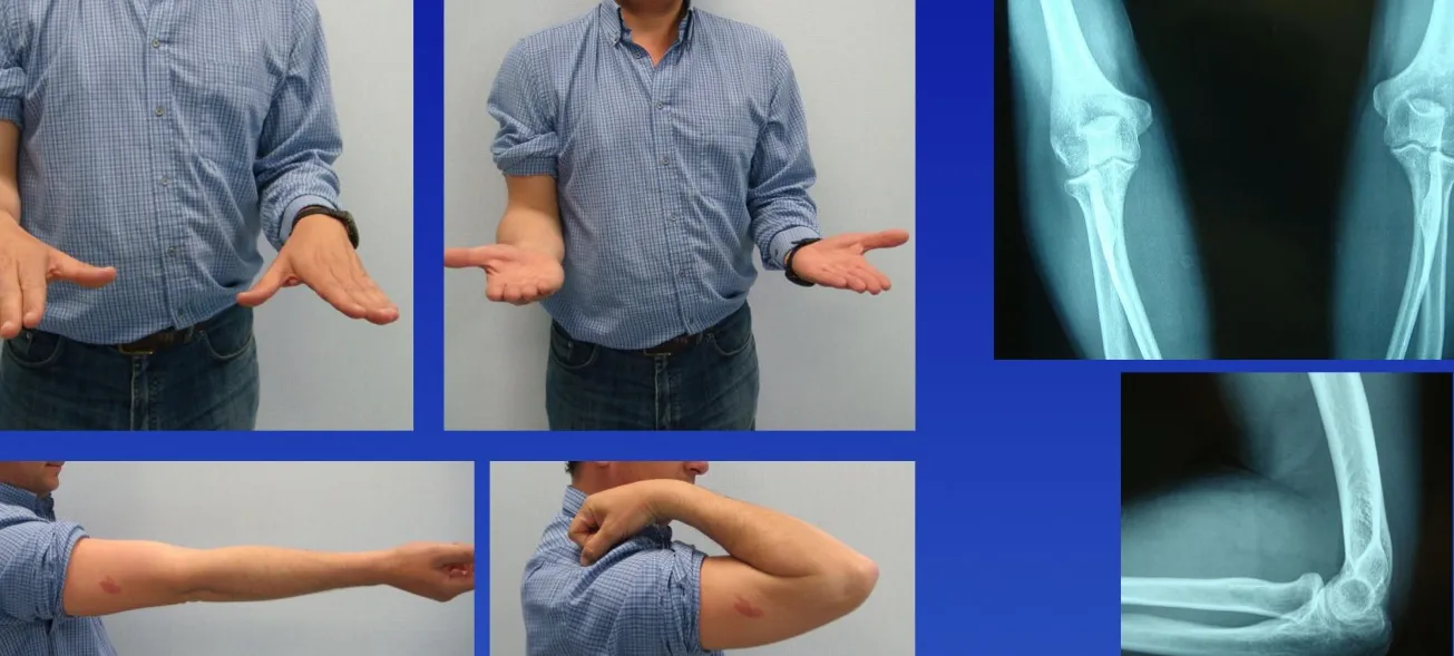 Corres y duele la rodilla: ¿Plica Sinovial o algo más?