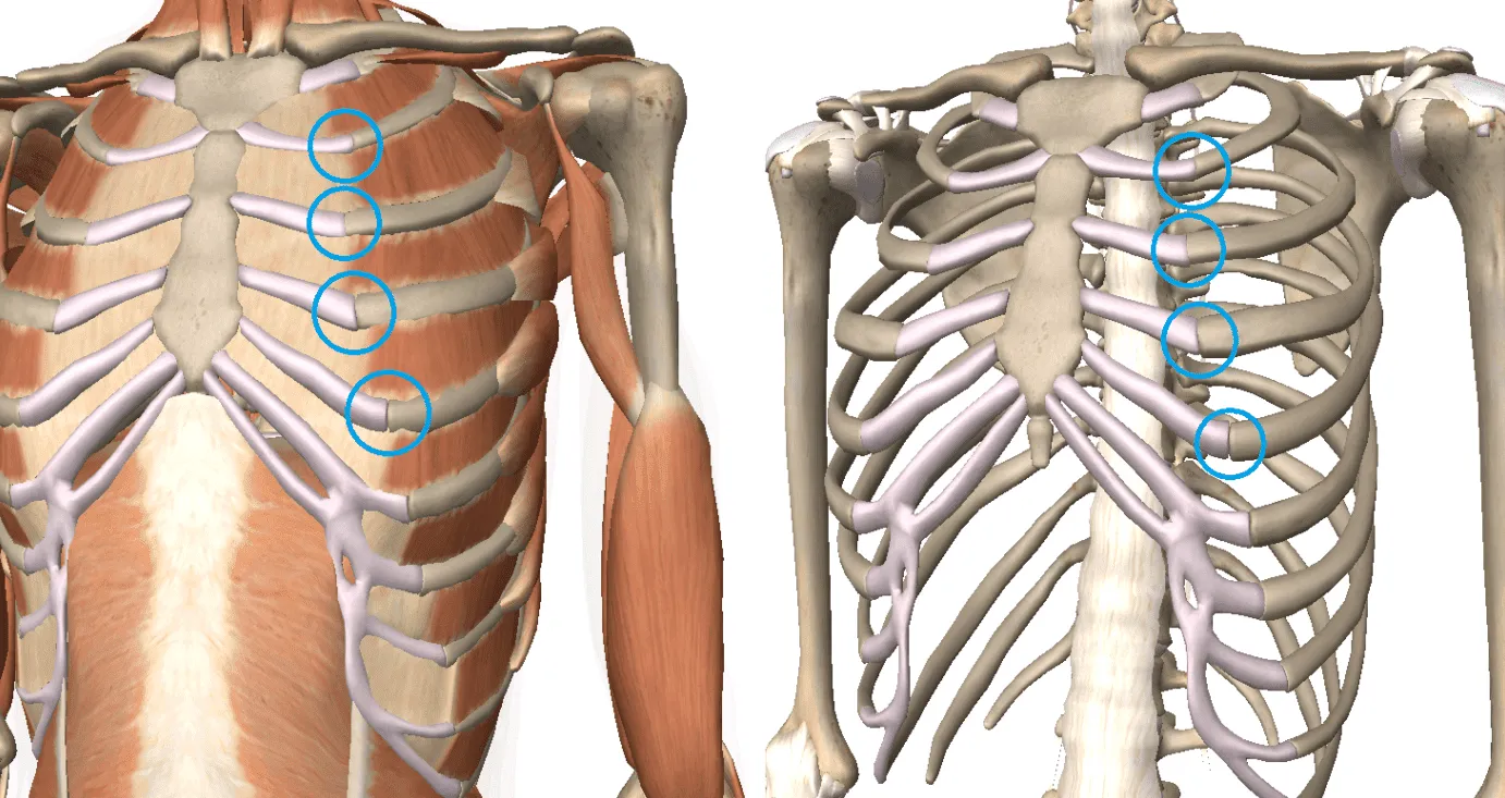 Síndrome de Tietze (afectando los cartílagos pectorales)