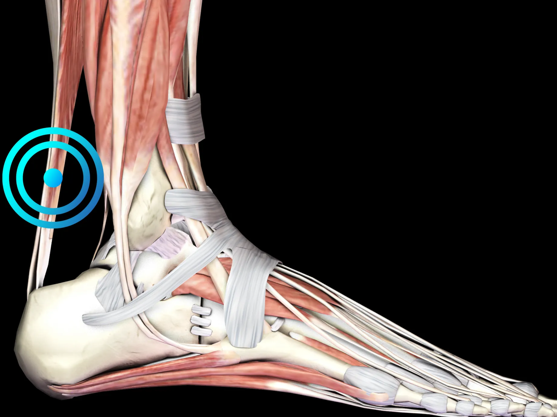 Tendinitis de Aquiles (Talón)