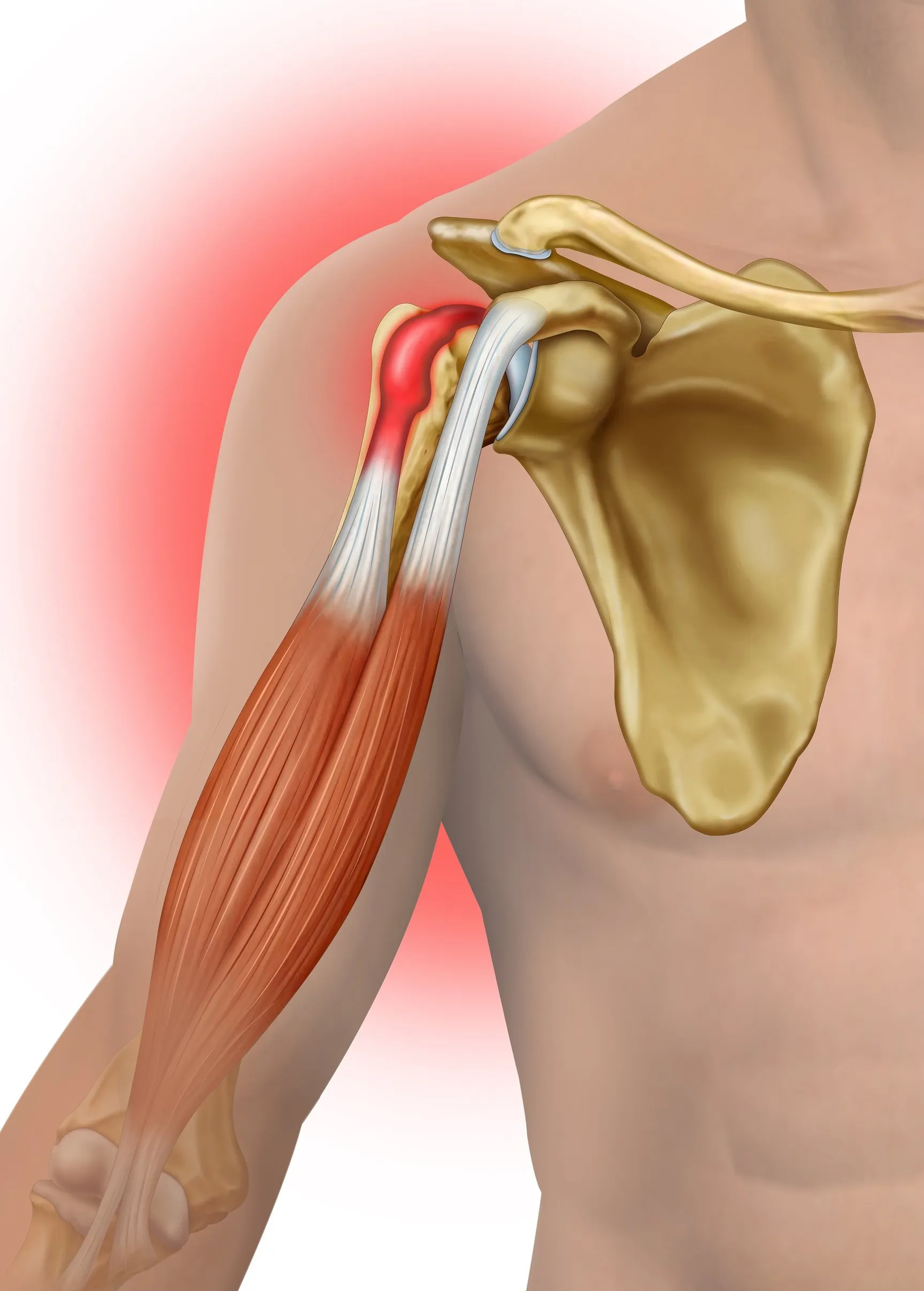 Tendinitis del Braquial (Brazo)
