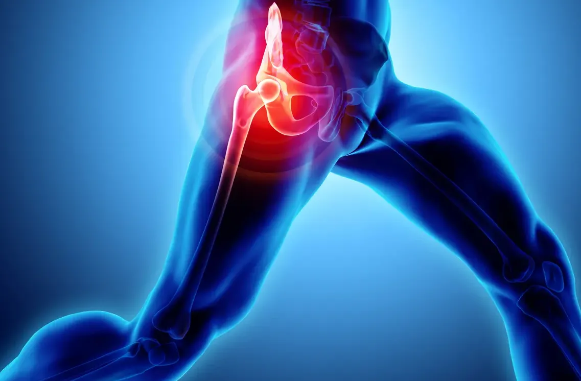 Tendinitis del Glúteo Mínimo (Cadera)