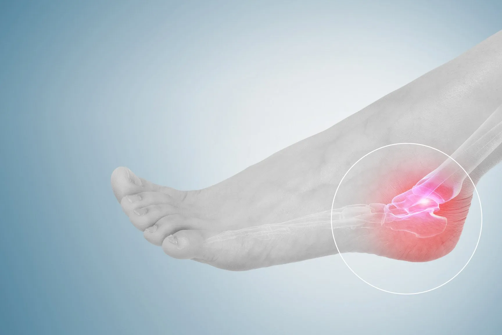Tendinitis de los Peroneos (Tobillo y Pie)