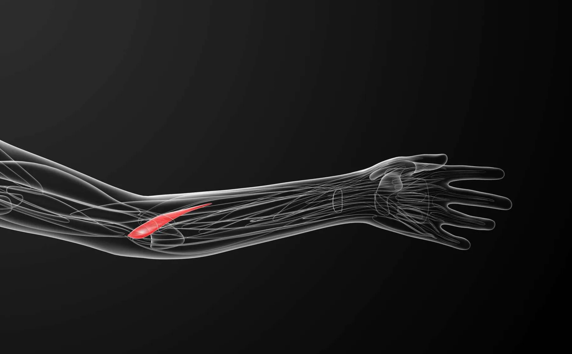 Tendinitis del Pronador Redondo (Antebrazo)
