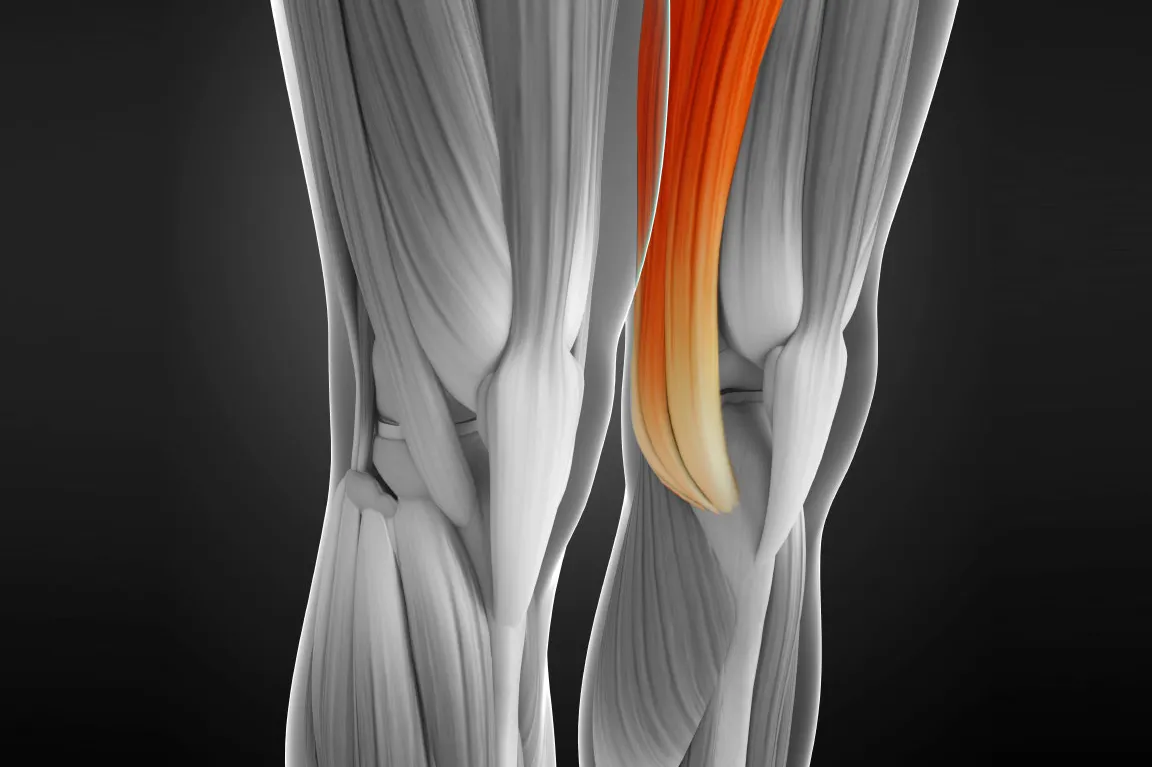Tendinitis del Semimembranoso (Muslo y Rodilla)
