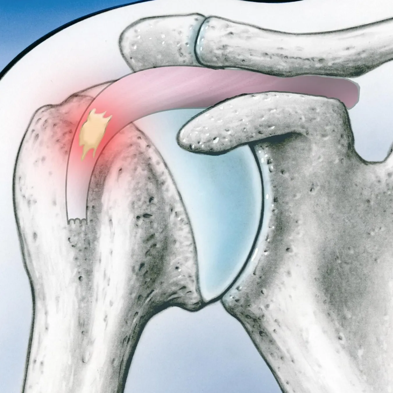 Tendinitis del Supraespinoso (Hombro)
