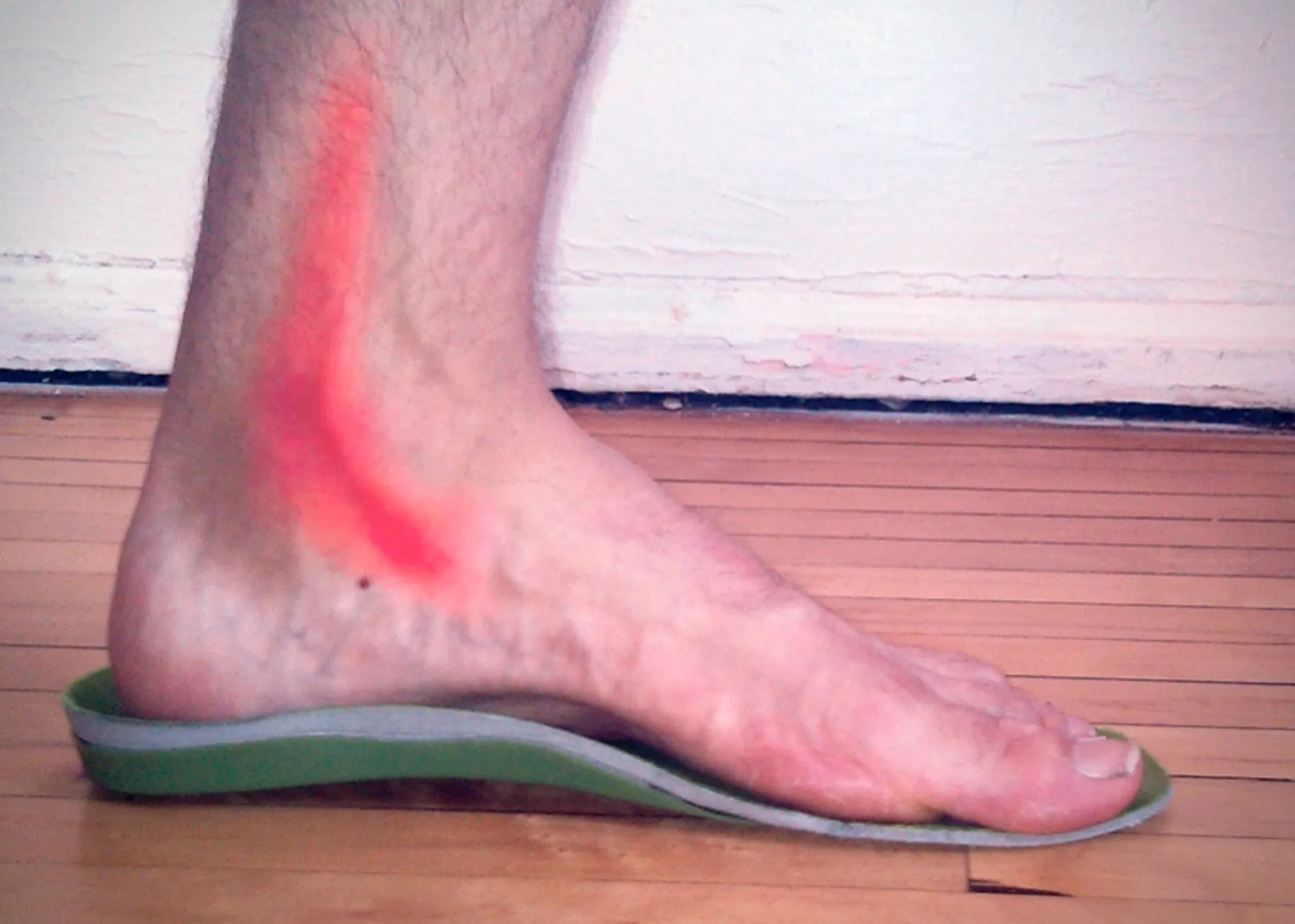 Tendinitis del Tibial Posterior (Tobillo)