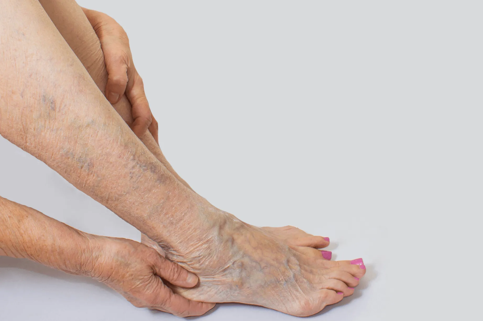 Varices y Problemas Vasculares en la Pantorrilla