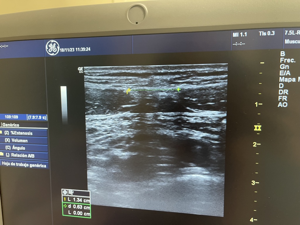 Fisioterapia para cerrar la Diástasis abdominal 2 6802F5C9 BD04 414E A47F 5ECFE1F1114E 1 105 c