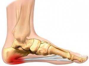 Recepción Explosiva: Protege tu Fascia Plantar