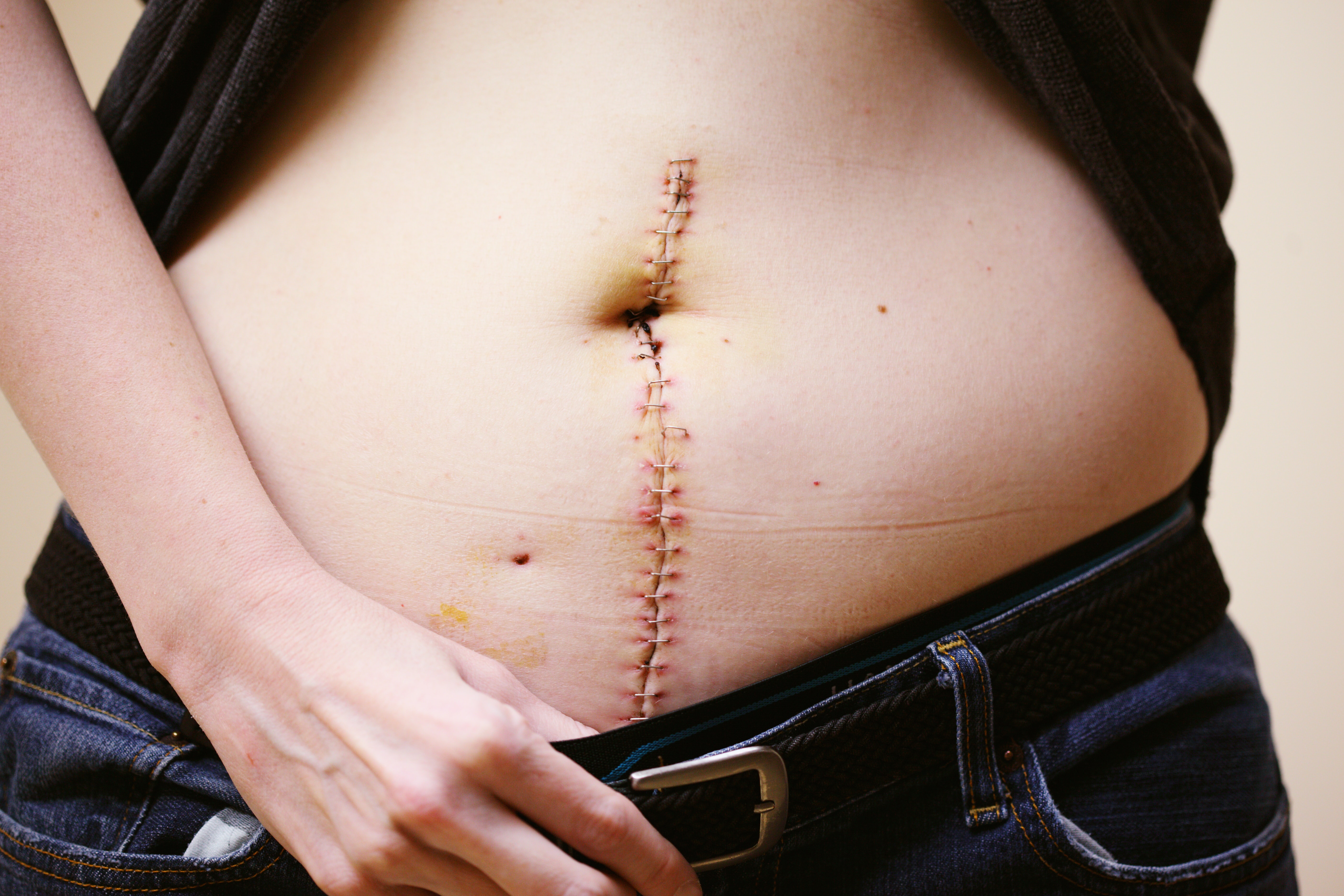Dolor de cicatriz ¿qué es y como tratarlo?
