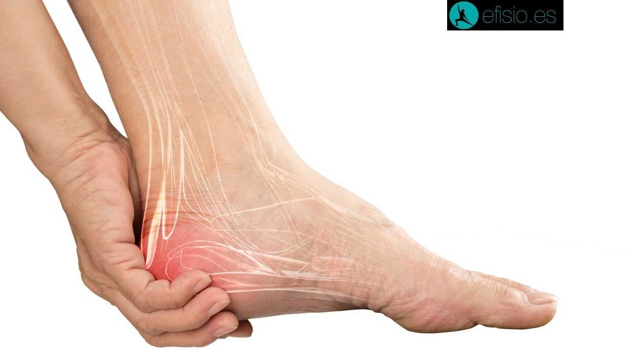 Fascitis plantar: El muro invisible para corredores