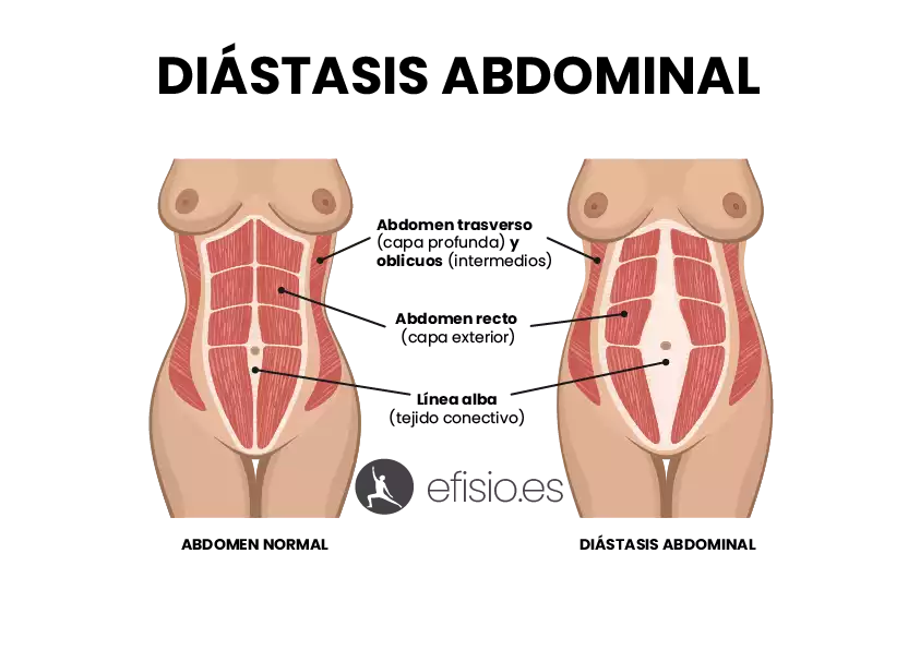 Diástasis Abdominal: Recupera tu Core Tras el Embarazo