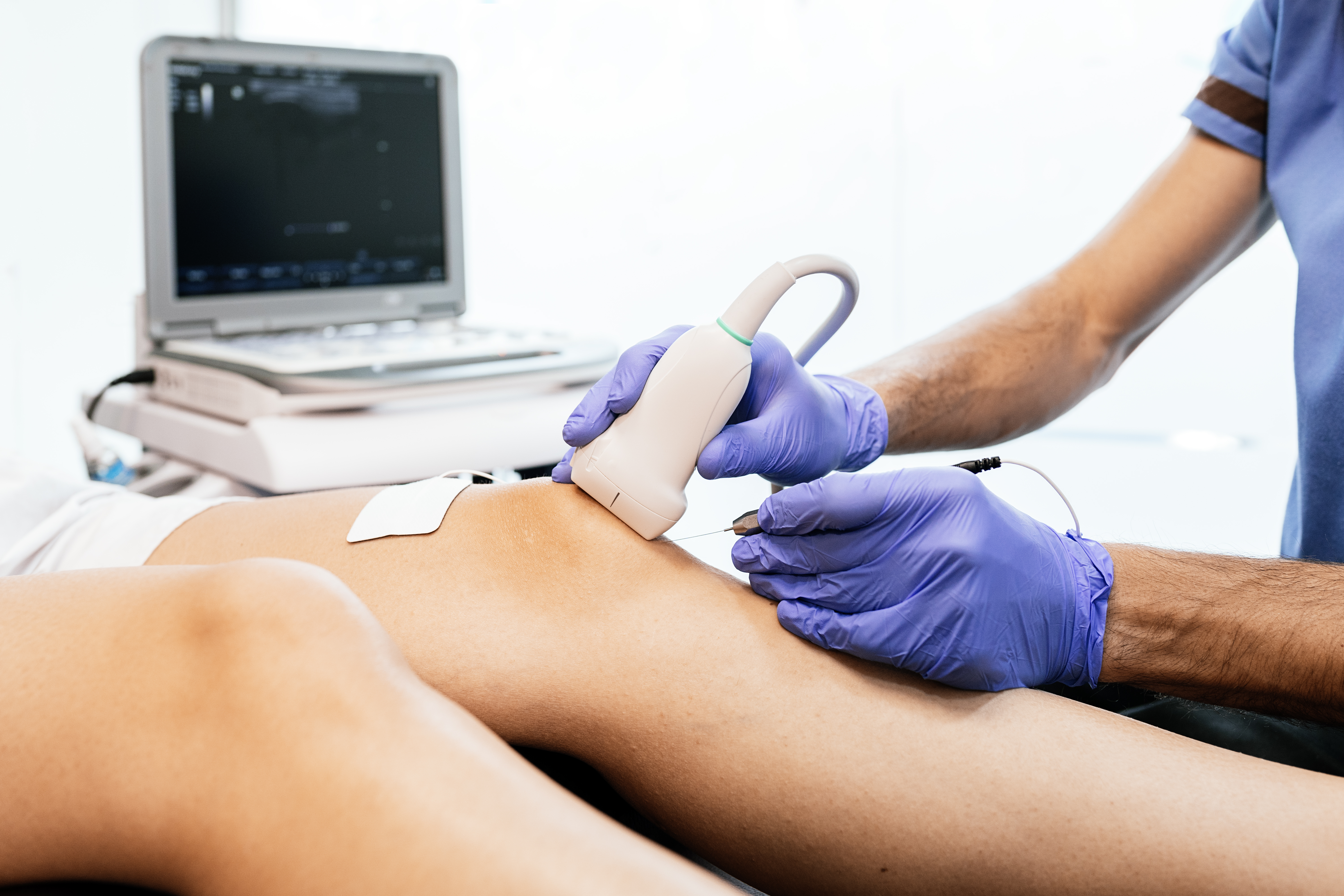 Tendinitis del cuádriceps: Tratamiento con punción seca y electrolisis percutánea EPTE