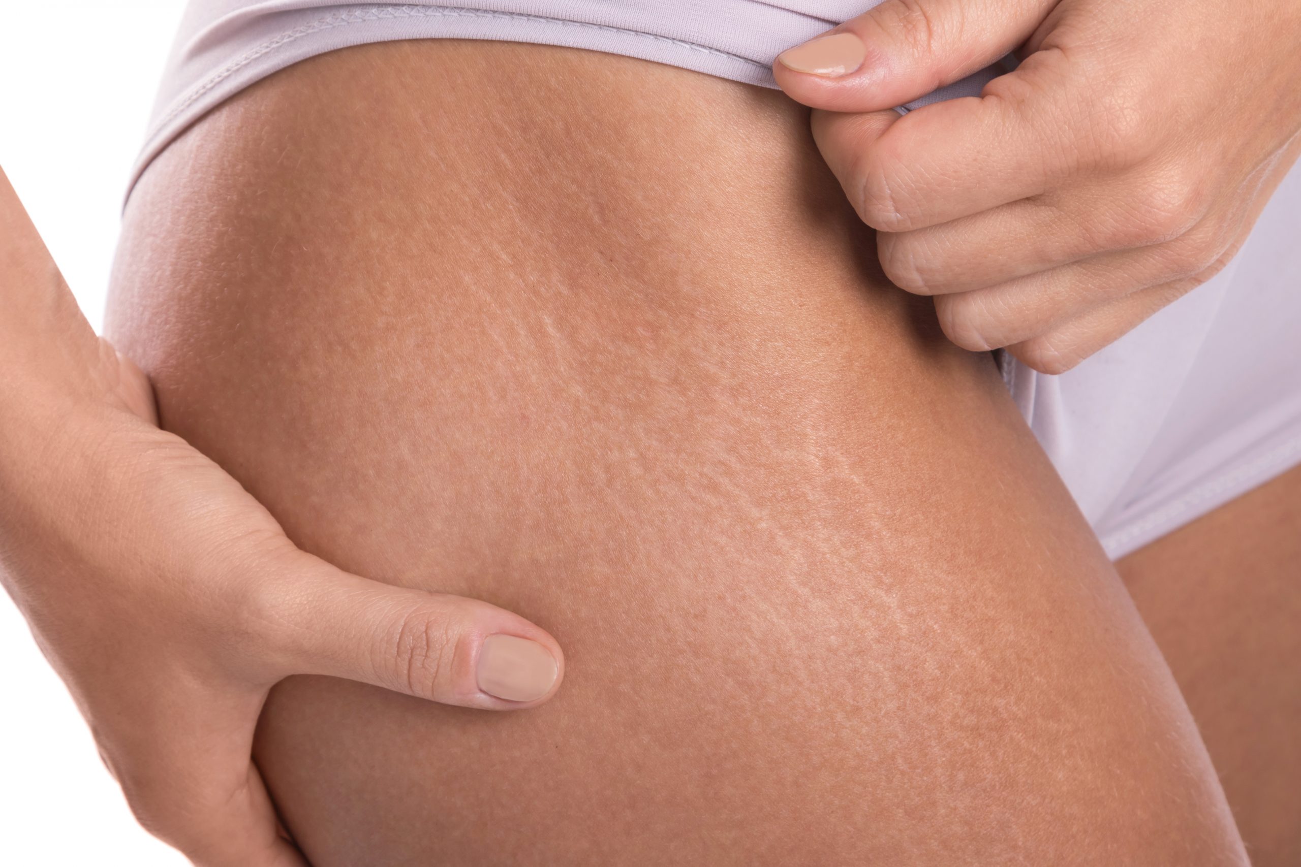 Como combatir la Celulitis con Ondas de choque