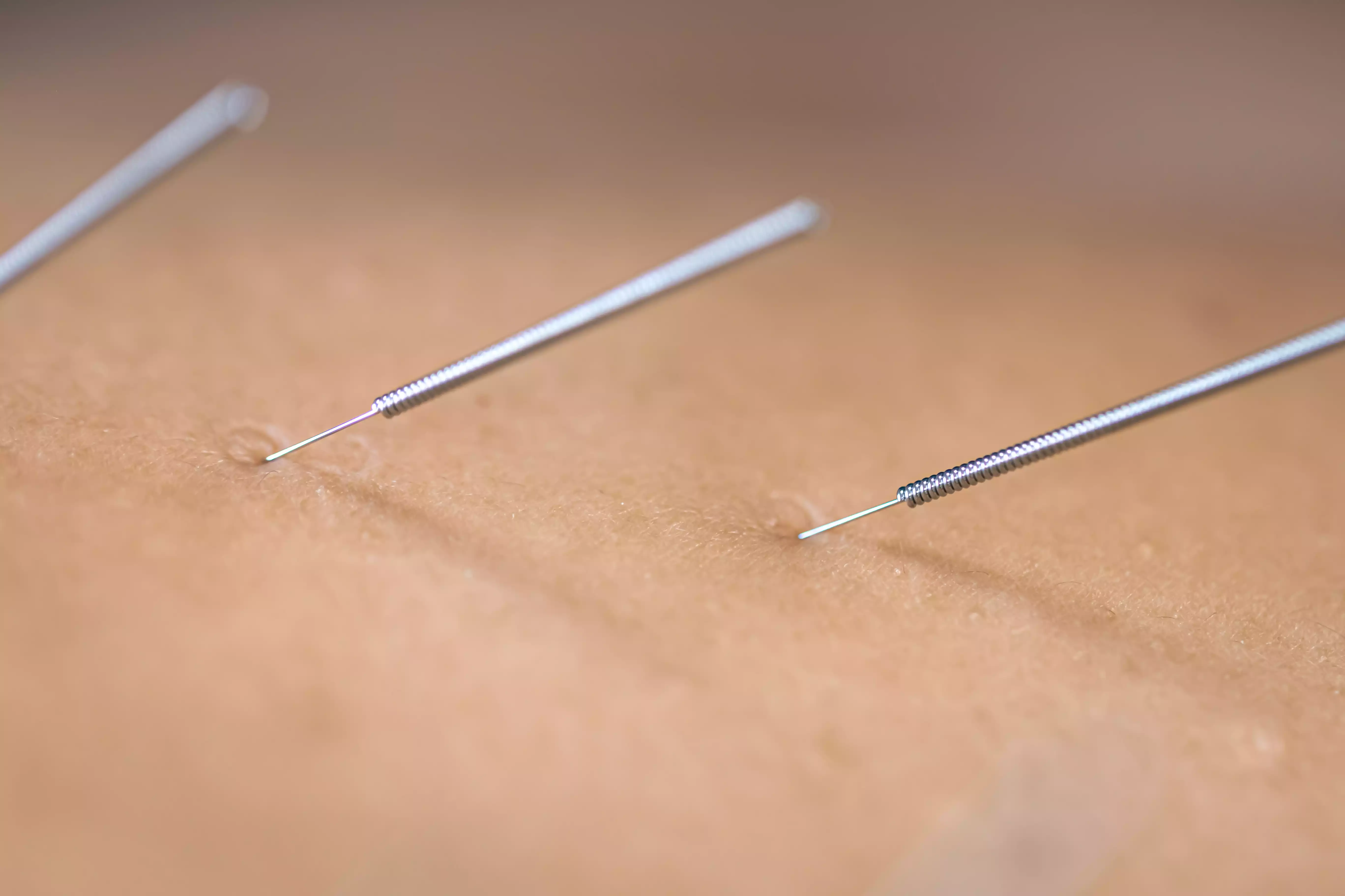 Pinzamiento del nervio cubital: Cuando tu codo sabotéa tu mano