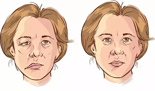 Parálisis Facial: Cuando el Origen Sorprende