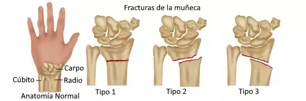 El hombro tras la fractura de muñeca: la conexión inesperada