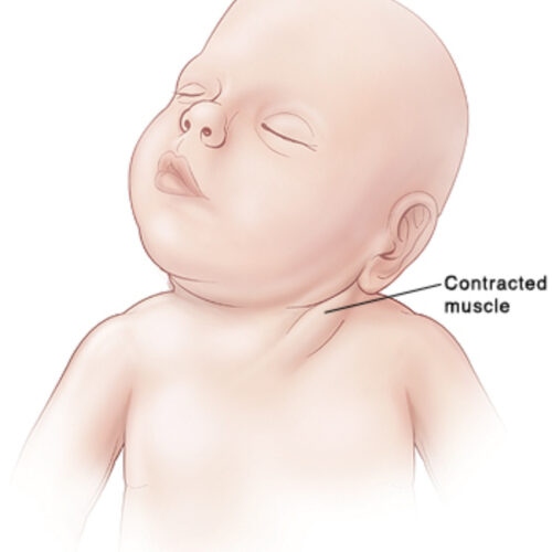 Bebe con tortícolis