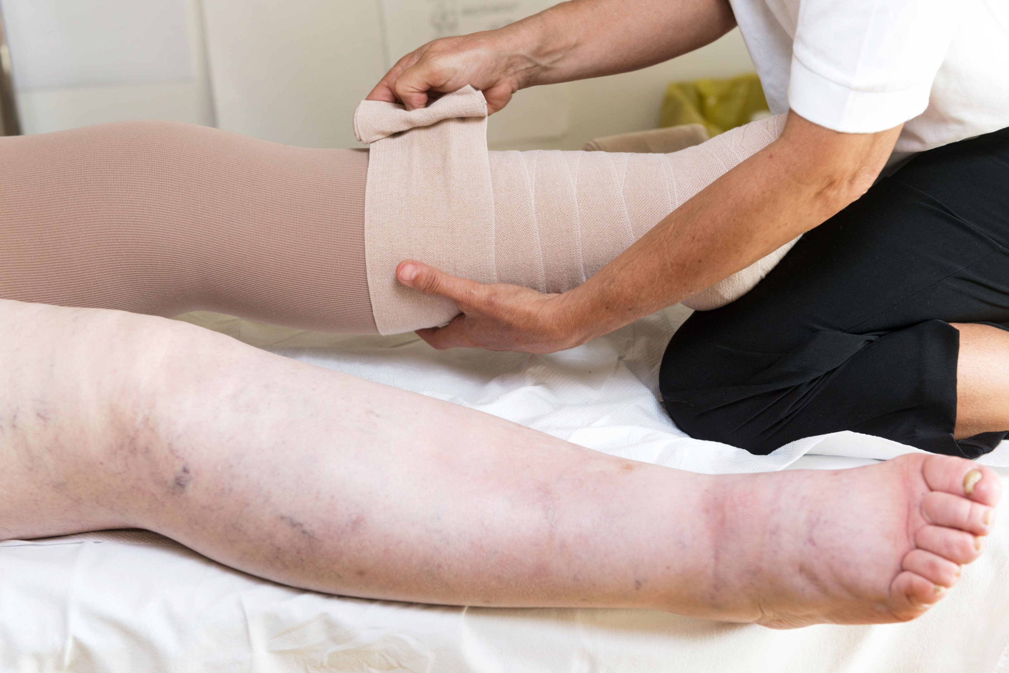 Tratamientos del Linfedema con Fisioterapia